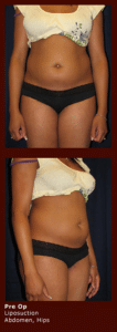 liposuction at Georgetown Plastic Surgery