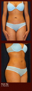 liposuction at Georgetown Plastic surgery