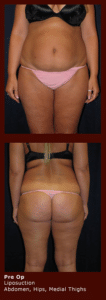 liposuction at georgetown plastic surgery