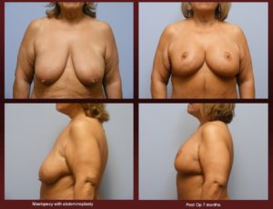 breast reduction at Georgetown Plastic Surgery
