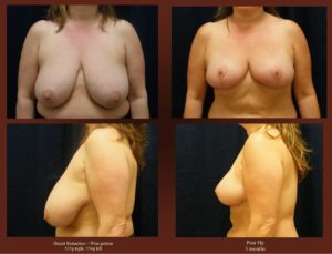 Breast Reduction at Georgetown Plastic Surgery