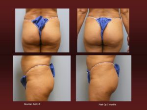 Brazilian butt lift at Georgetown Plastic Surgery
