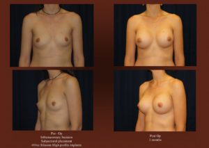 Breast Augmentation at Georgetown Plastic Surgery