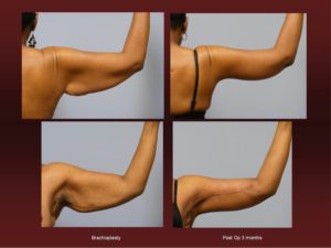 Arm Lift at Georgetown Plastic Surgery