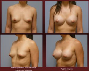 Breast Augmentation Before/after