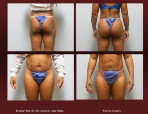 Brazilian Butt Lift at georgetown plastic surgery