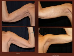 arm Lift at Georgetown Plastic Surgery