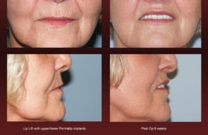 Lip enhancement at Georgetown Plastic Surgery