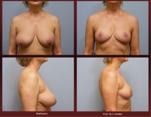 Breast Lift at Georgetown Plastic Surgery