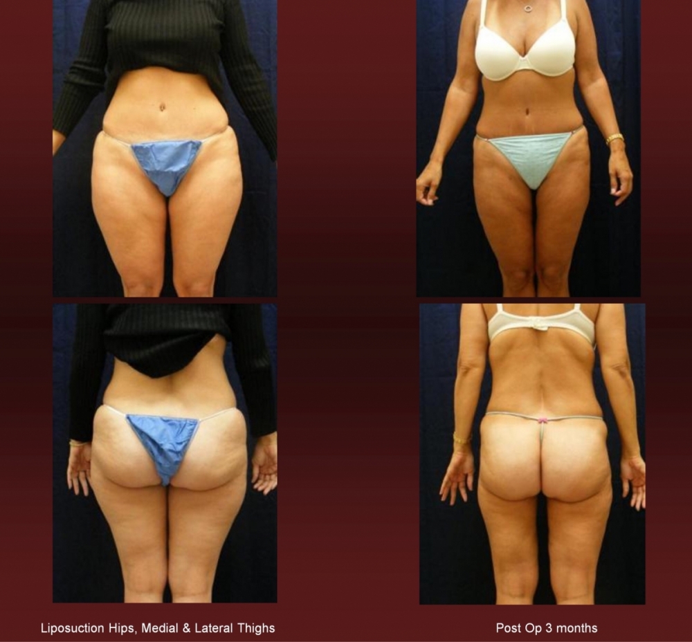 Liposuction at Georgetown Plastic Surgery