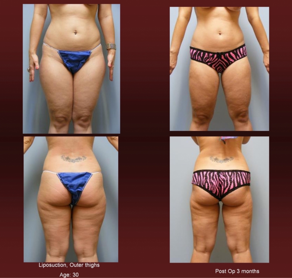 Liposuction at Georgetown Plastic Surgery
