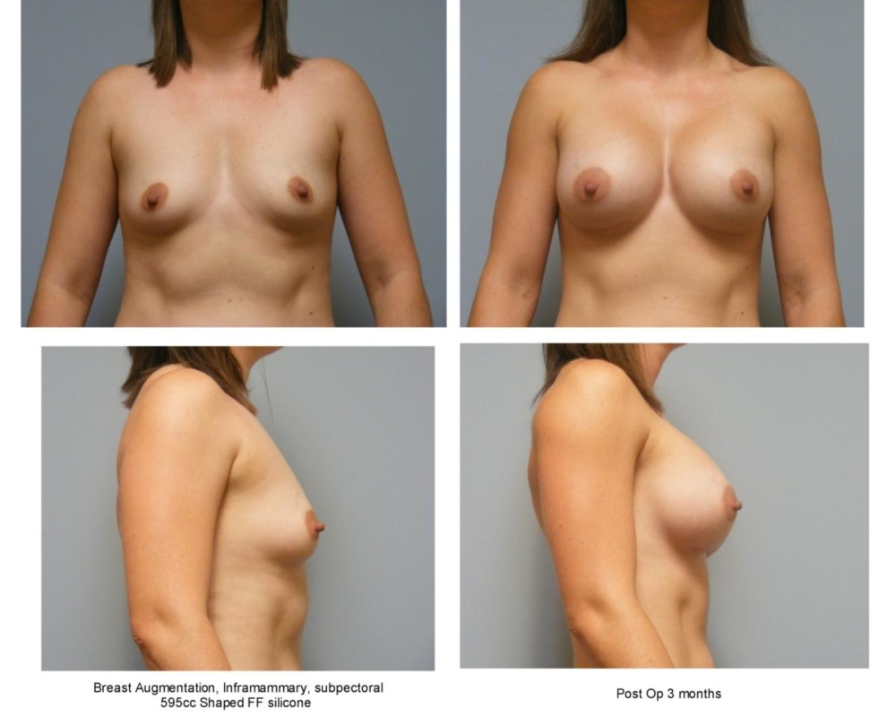 Breast Augmentation at Georgetown Plastic Surgery