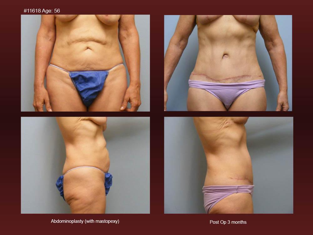 Before and After Photos - Abdominoplasty (10)