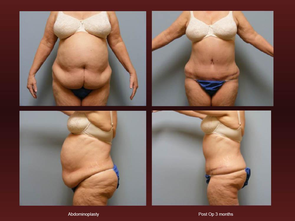 Before and After Photos - Abdominoplasty (11)