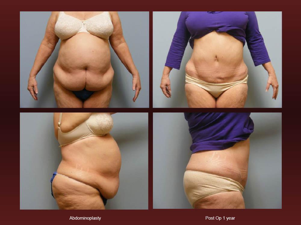 Before and After Photos - Abdominoplasty (12)