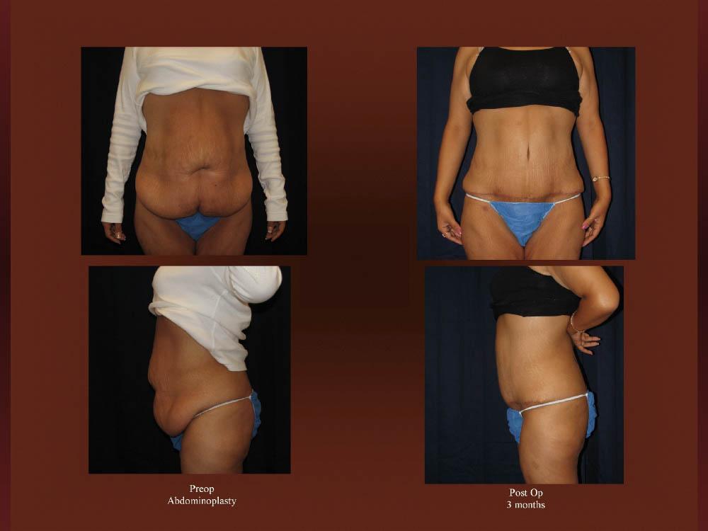 Before and After Photos - Abdominoplasty (14)