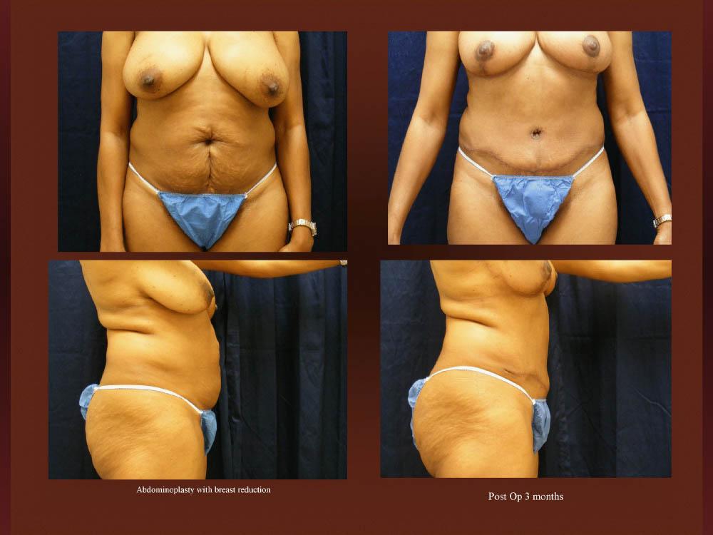 Before and After Photos - Abdominoplasty (15)