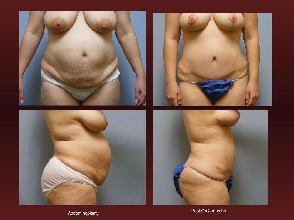 Before and After Photos - Abdominoplasty (16)