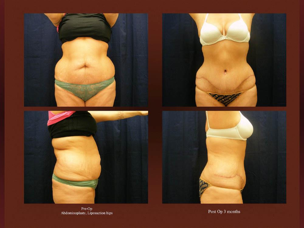 Before and After Photos - Abdominoplasty (17)