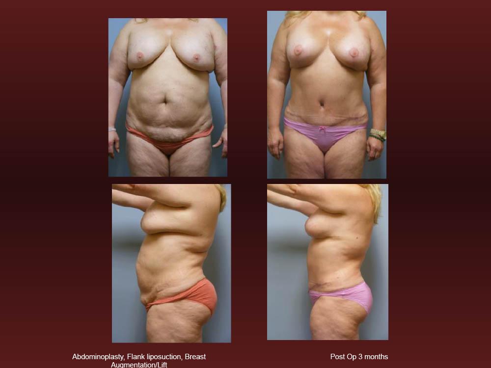 Before and After Photos - Abdominoplasty (18)