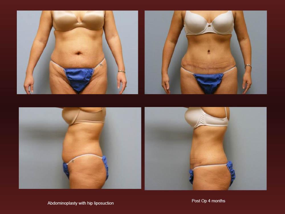 Before and After Photos - Abdominoplasty (19)