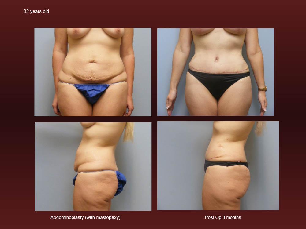 Before and After Photos - Abdominoplasty (2)