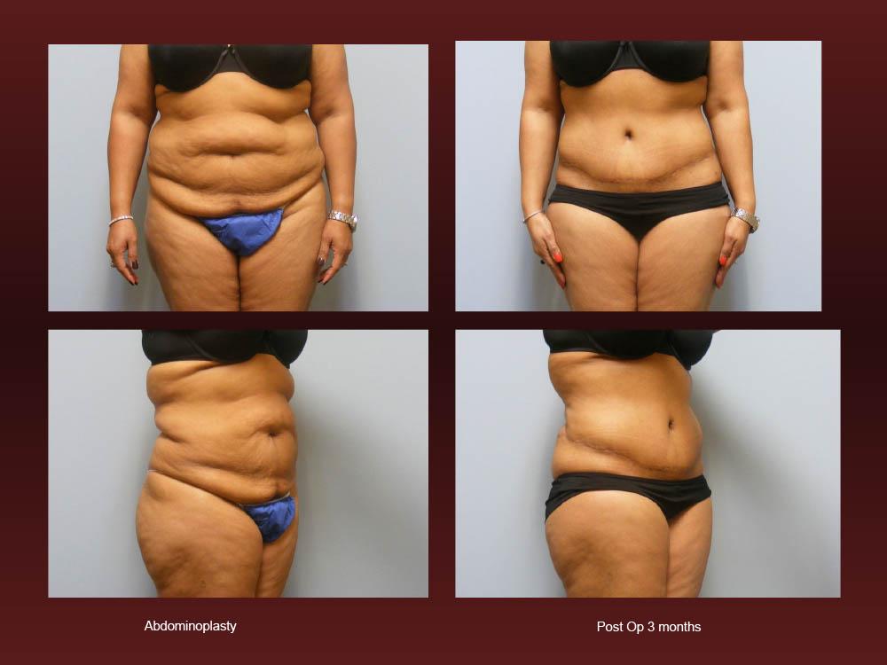 Before and After Photos - Abdominoplasty (20)