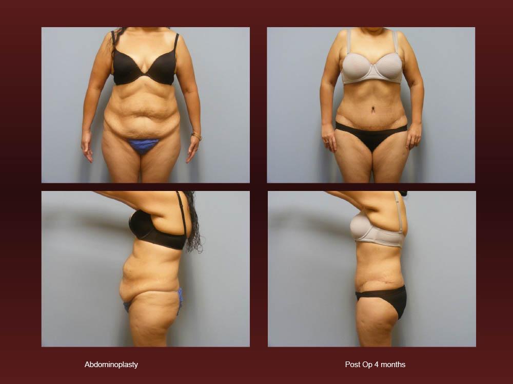 Before and After Photos - Abdominoplasty (21)
