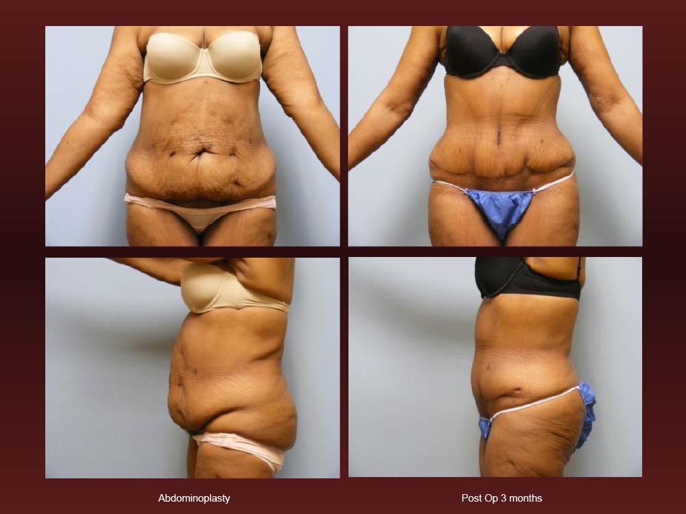 Before and After Photos - Abdominoplasty (25)