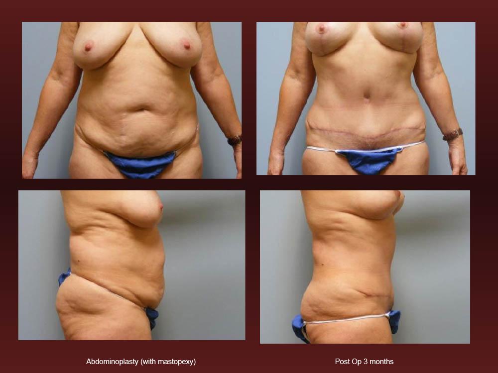 Before and After Photos - Abdominoplasty (3)