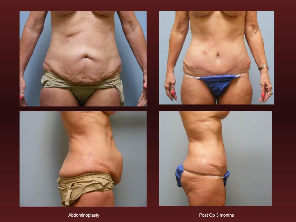 Before and After Photos - Abdominoplasty (30)