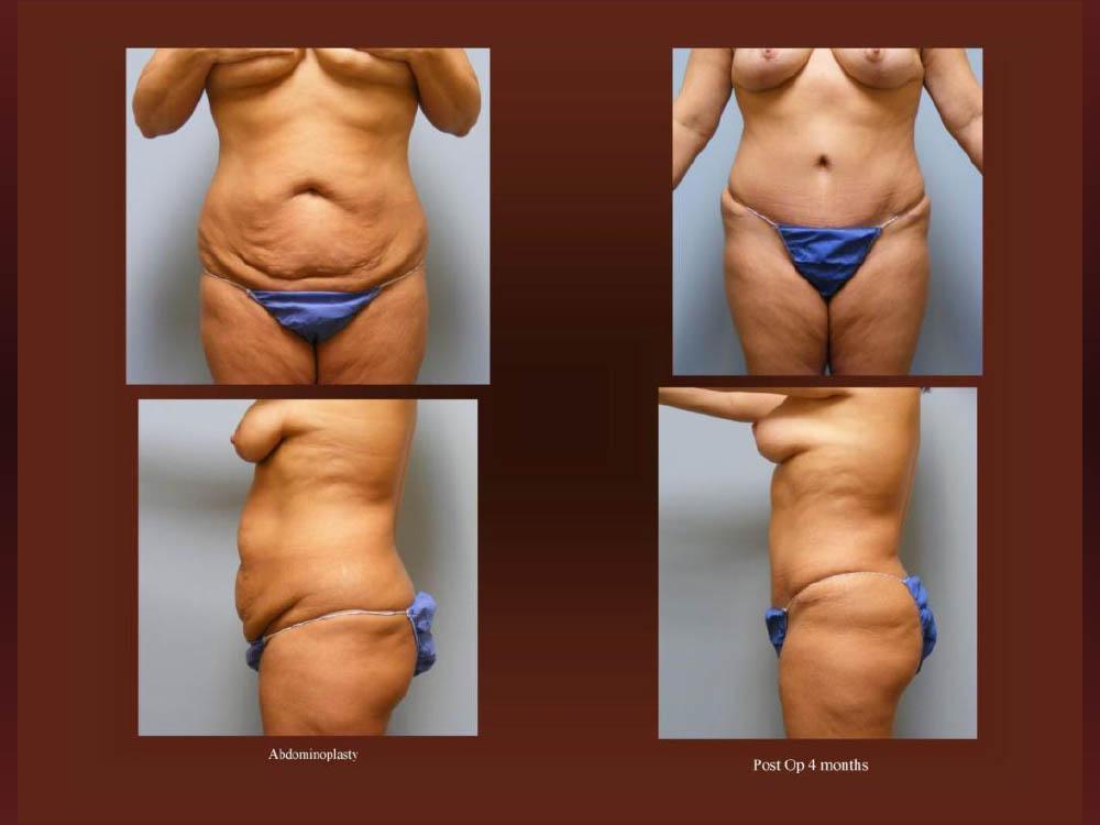 Before and After Photos - Abdominoplasty (31)