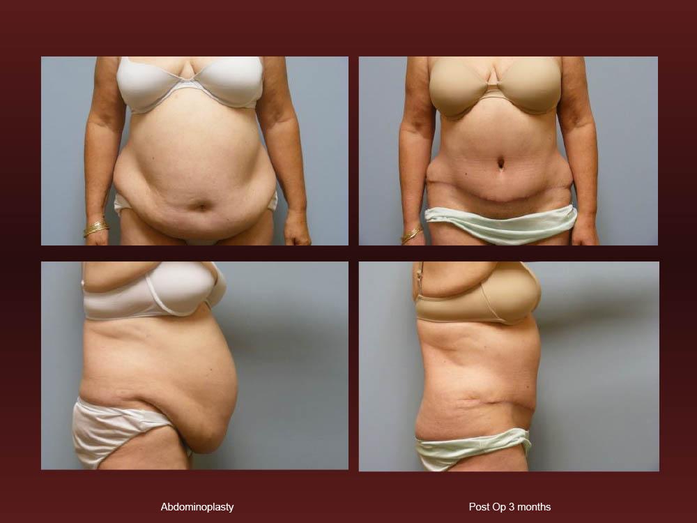 Before and After Photos - Abdominoplasty (32)