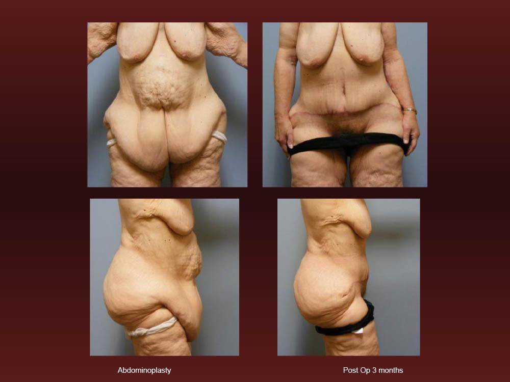 Before and After Photos - Abdominoplasty (34)