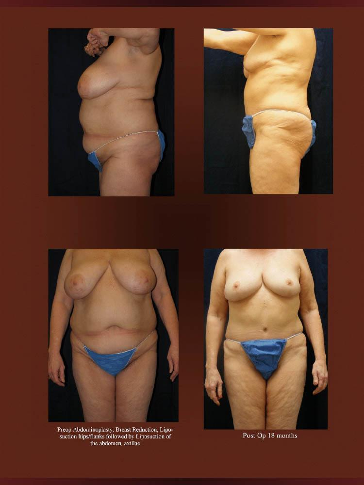 Before and After Photos - Abdominoplasty (35)