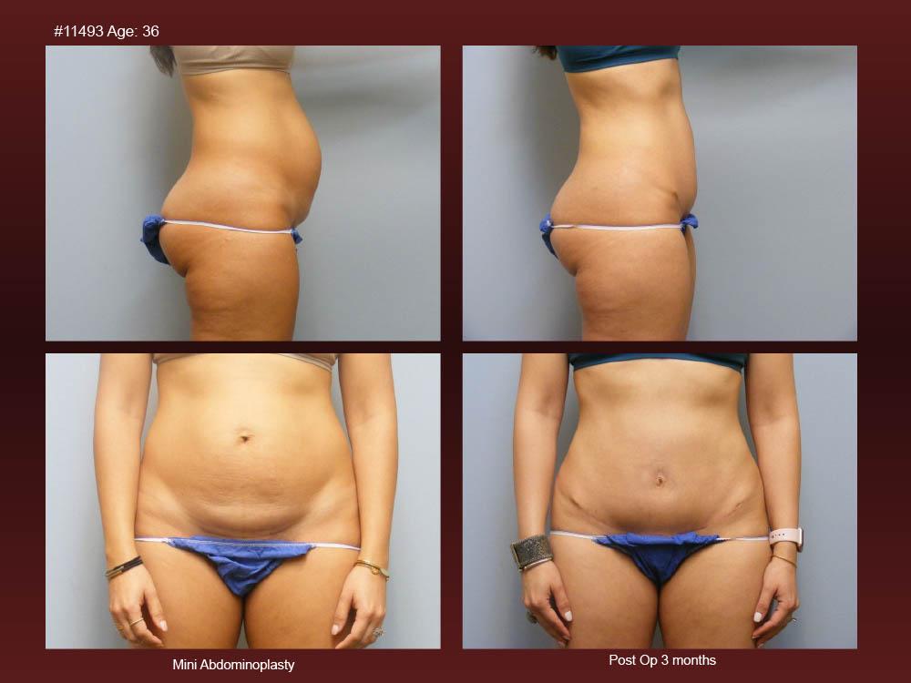 Before and After Photos - Abdominoplasty (38)