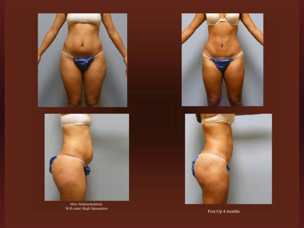 Before and After Photos - Abdominoplasty (39)