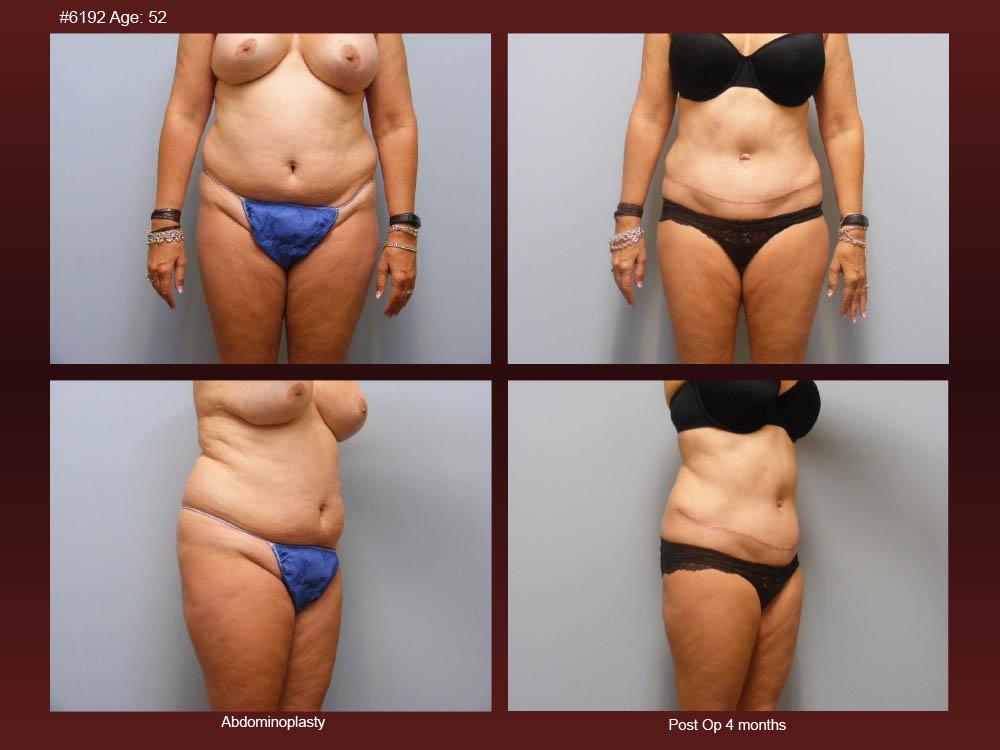 Before and After Photos - Abdominoplasty (4)