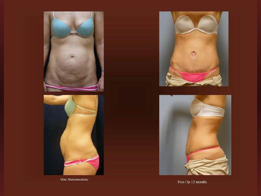 Before and After Photos - Abdominoplasty (41)