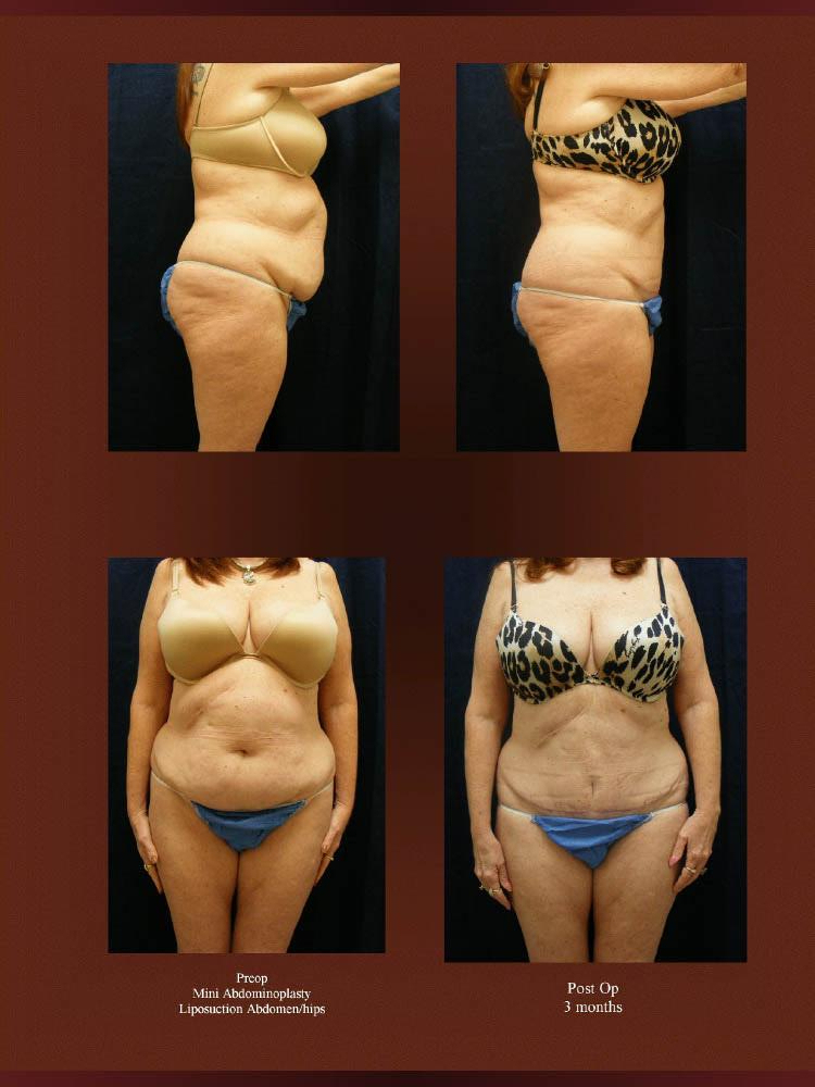 Before and After Photos - Abdominoplasty (42)