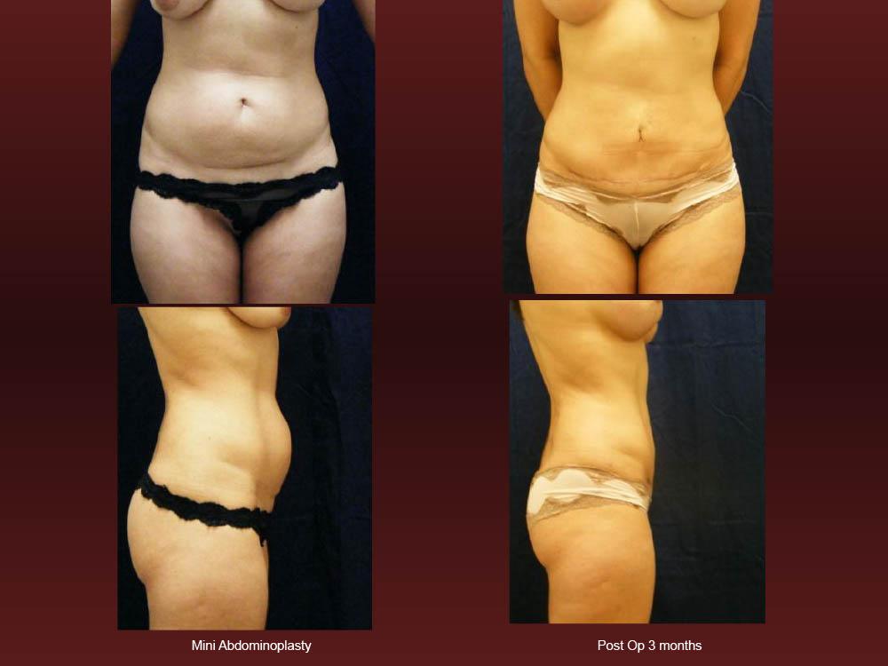 Before and After Photos - Abdominoplasty (43)