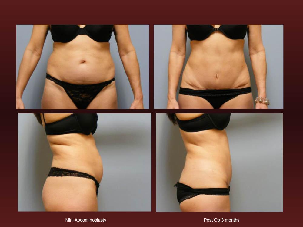 Before and After Photos - Abdominoplasty (44)