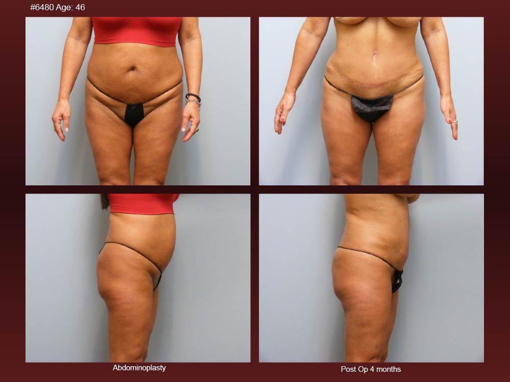 Before and After Photos - Abdominoplasty (5)