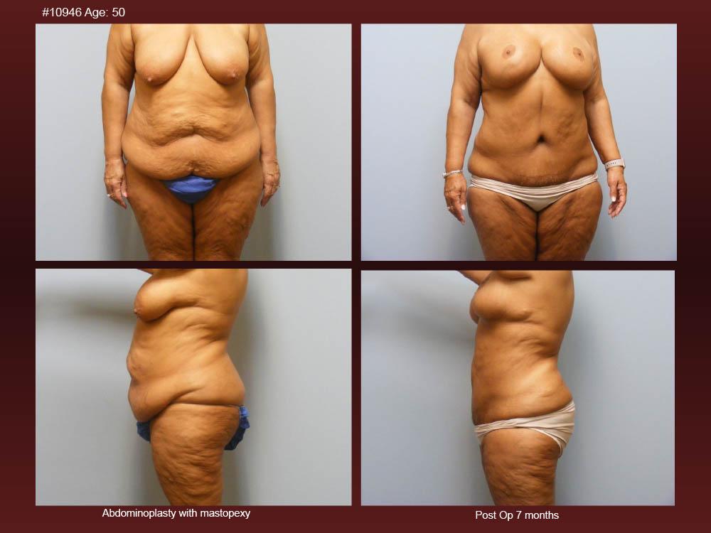 Before and After Photos - Abdominoplasty (6)