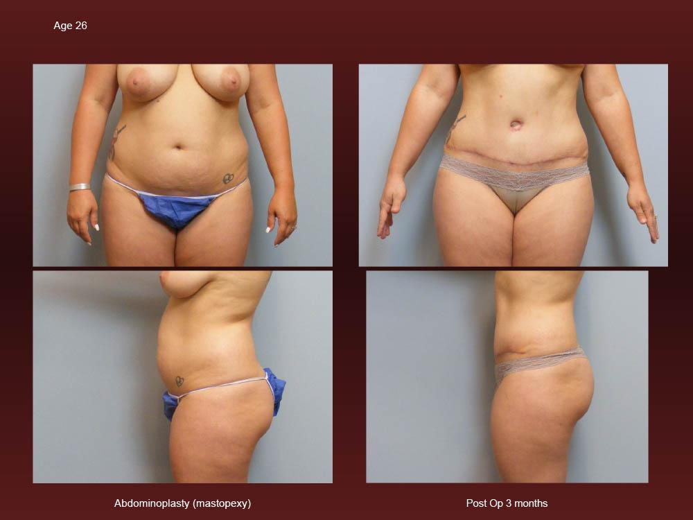 Before and After Photos - Abdominoplasty (7)