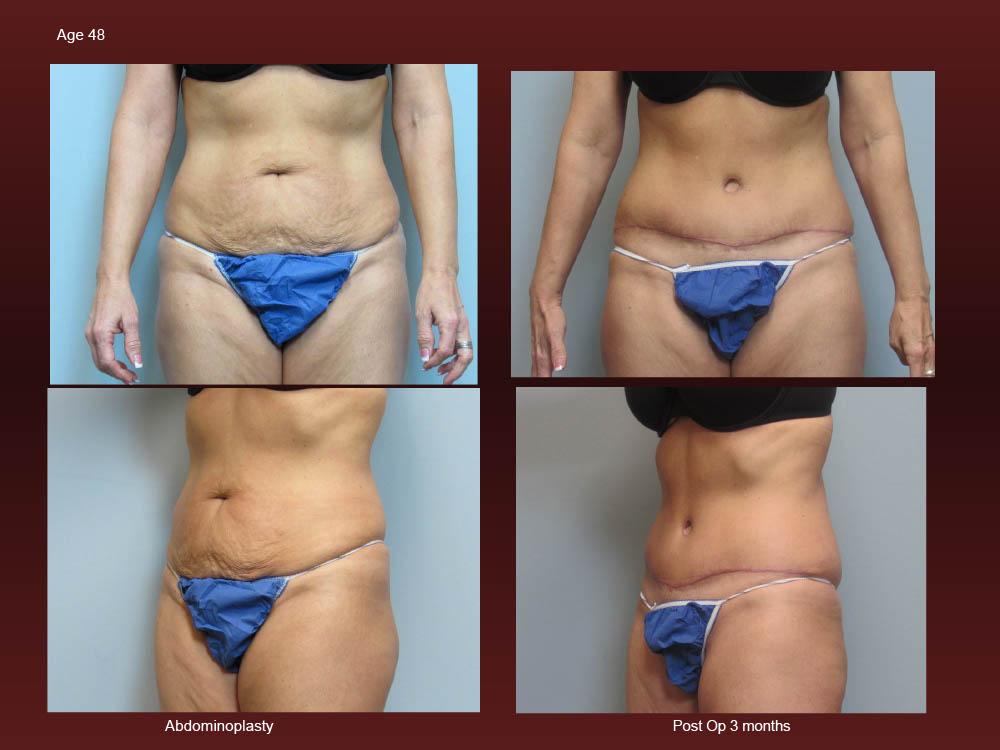 Before and After Photos - Abdominoplasty (9)