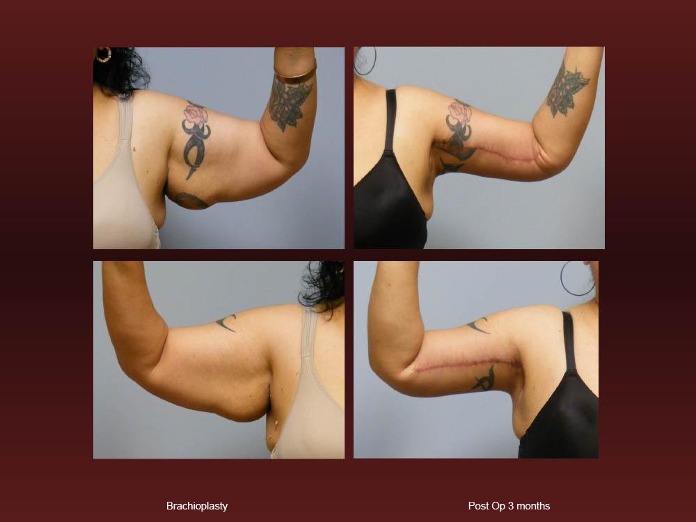 Before and After Photos - Arm Lifts (10)