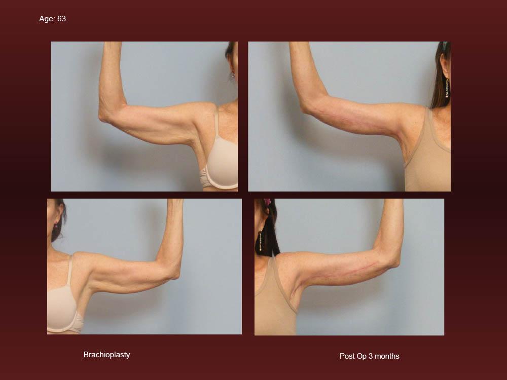 Before and After Photos - Arm Lifts (3)