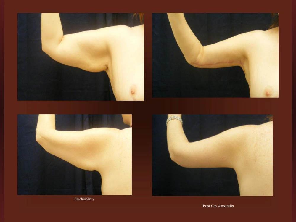 Before and After Photos - Arm Lifts (7)