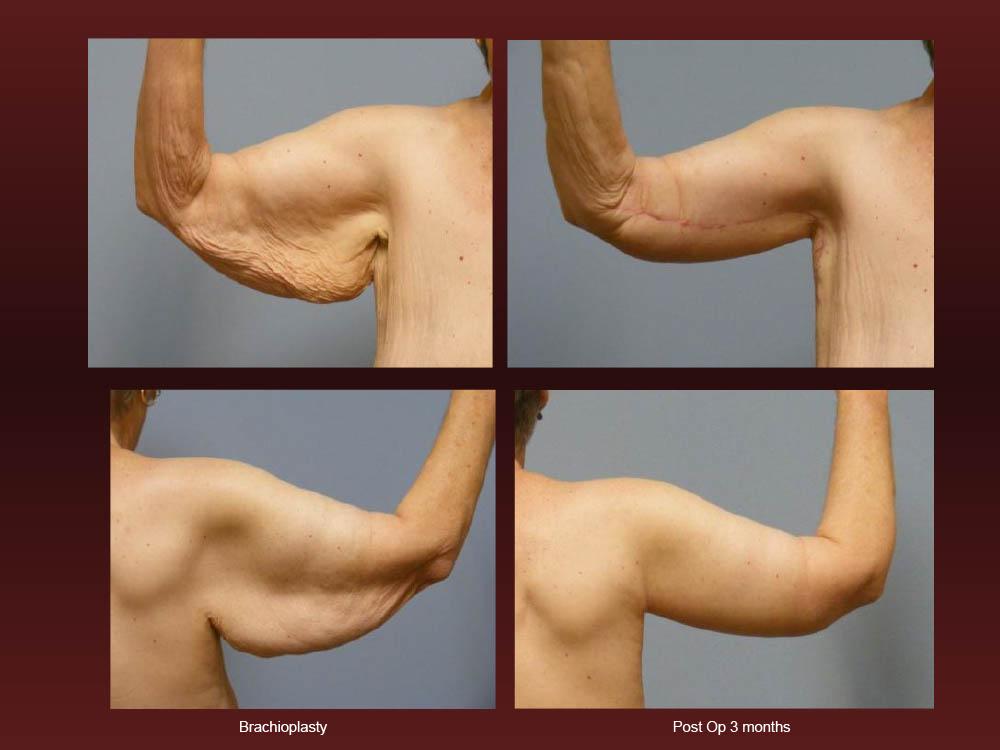 Before and After Photos - Arm Lifts (9)